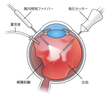 日帰り網膜硝子体手術のイメージ